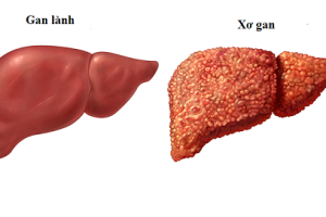 XƠ GAN DO RƯỢU: TRIỆU CHỨNG – NGUYÊN NHÂN – CÁCH ĐIỀU TRỊ