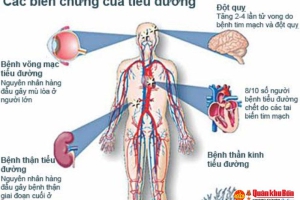 Tiểu đường – ĐỪNG ĐỢI KHÁT NƯỚC MỚI LO?