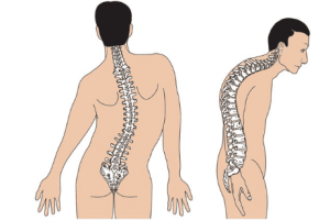 Xẹp đốt sống là gì? 