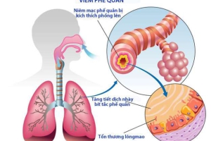 VIÊM PHẾ QUẢN: NGUYÊN NHÂN, TRIỆU CHỨNG & CÁCH ĐIỀU TRỊ