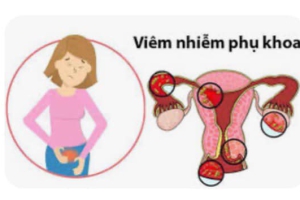 VIÊM NHIỄM PHỤ KHOA – DỄ HAY KHÓ