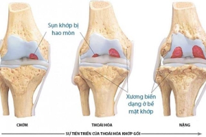 THOÁI HÓA KHỚP????