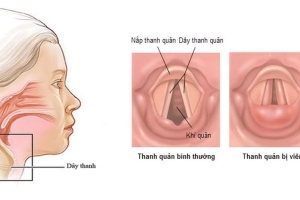  KHÀN TIẾNG  NGUYÊN NHÂN VÀ CÁCH PHÒNG TRÁNH 