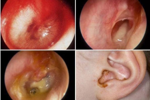 BỆNH VIÊM TAI GIỮA ?