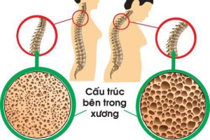 BỆNH LOÃNG XƯƠNG SAU MÃN KINH DO ĐÂU?