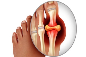  GOUT CẤP TÍNH LÀ GÌ? NHỮNG ĐIỀU CẦN BIẾT VỀ GOUT CẤP TÍNH