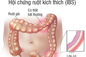HỘI CHỨNG RUỘT KÍCH THÍCH: ĂN XONG LÀ KHÓ CHỊU