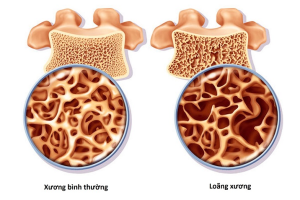 LOÃNG XƯƠNG: KHÔNG ĐAU NHƯNG RỦI RO LỚN