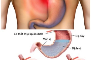 TRÀO NGƯỢC DẠ DÀY – THỰC QUẢN LÀ GÌ? 
