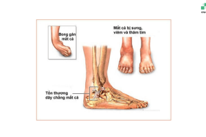 VIÊM KHỚP MẮT CÁ CHÂN LÀ GÌ?