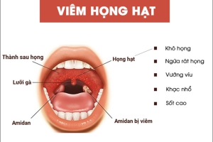 VIÊM HỌNG MẠN TÍNH: KHÔNG CHỈ LÀ ĐAU HỌNG THÔNG THƯỜNG
