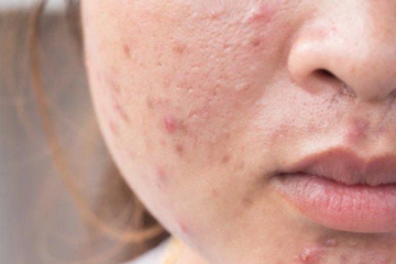 MỤN TRỨNG CÁ LÀ GÌ? 