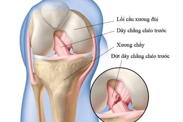 ĐỨT DÂY CHẰNG: TRIỆU CHỨNG – NGUYÊN NHÂN – ĐIỀU TRỊ
