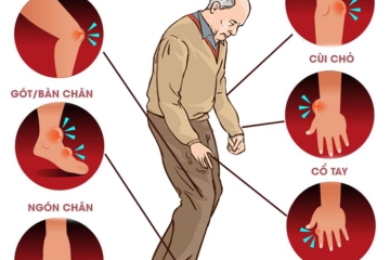  GOUT - CĂN BỆNH THỜI ĐẠI 