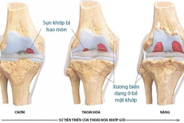 THOÁI HÓA KHỚP????