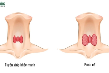 BƯỚU CỔ: TRIỆU CHỨNG – NGUYÊN NHÂN – CÁCH ĐIỀU TRỊ