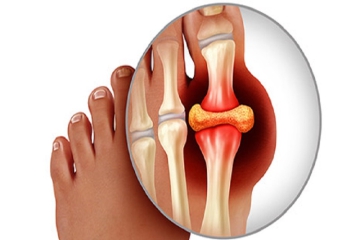  GOUT CẤP TÍNH LÀ GÌ? NHỮNG ĐIỀU CẦN BIẾT VỀ GOUT CẤP TÍNH