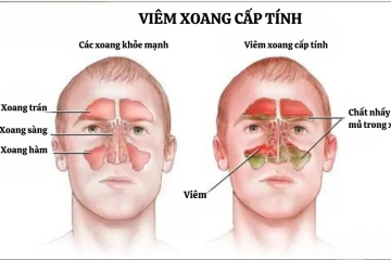 VIÊM XOANG: ĐỪNG XEM NHẸ CẢM GIÁC NGHẸT MŨI KÉO DÀI