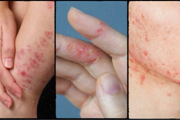 VIÊM DA DỊ ỨNG VÀ NHỮNG ĐIỀU BẠN NÊN BIẾT 